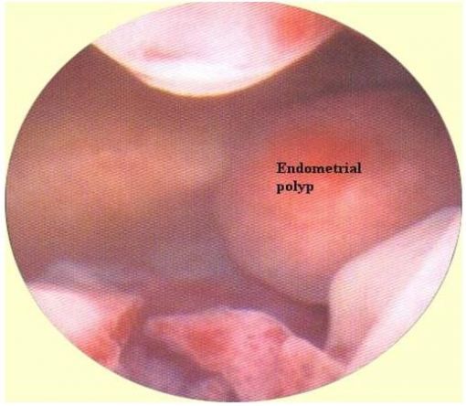  endometrial polip
